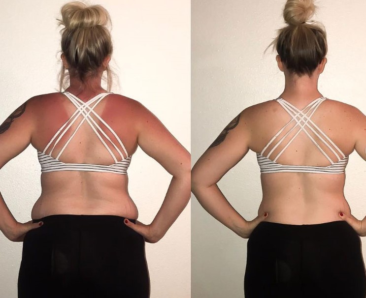 Woman back before and after weight photos