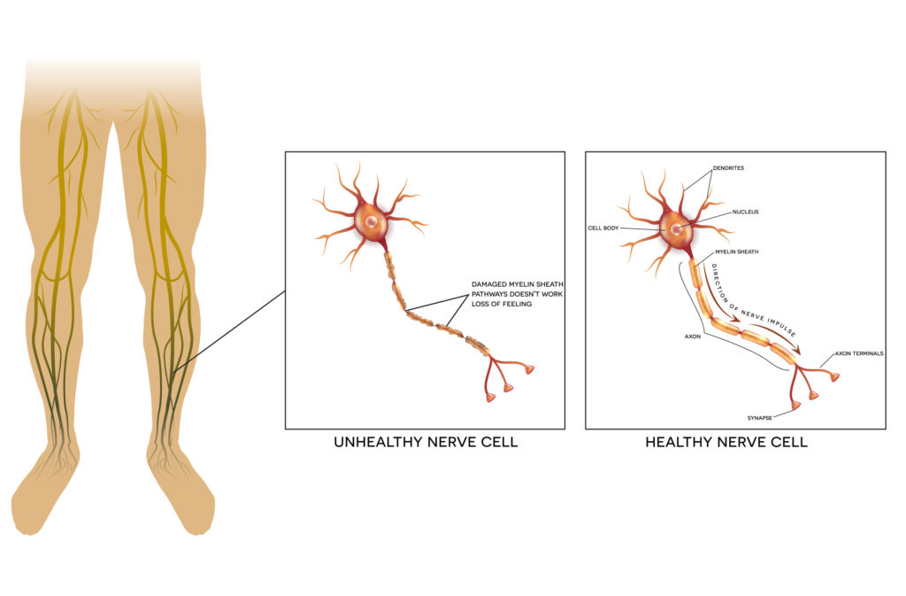 peripheral neuropathy diagram showing nerve damage